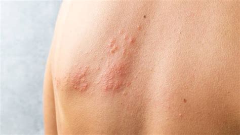 醫案分享丨生了蛇串瘡(生蛇)怎麼辦？！ – 醫天圓中醫診所