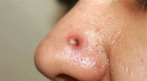 Nose Pimple Remedy | The News God