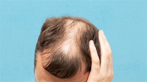 Is Hair Loss Genetic? Facts to Know - After SYBIL