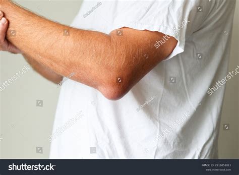 Man Swelling Erythematous Lump Pain Elbow Stock Photo 2216851011 ...