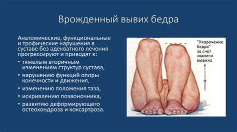 Физическая реабилитация детей с врожденным вывихом бедра - презентация ...