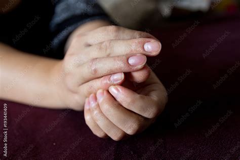 Eczema on the hands . Skin disease Stock Photo | Adobe Stock