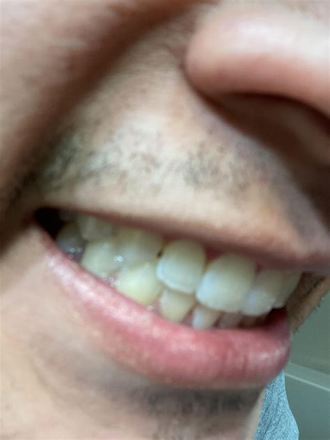 Why my teeth aren’t getting whiter? I went to the dentist office and