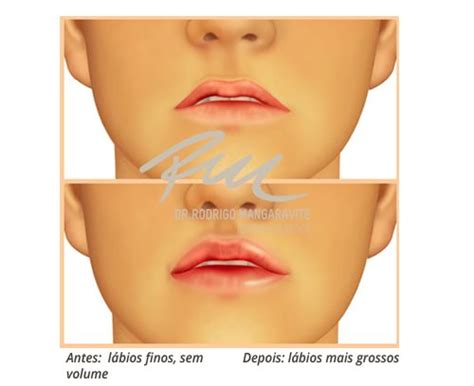 Cirurgia De Labio Leporino