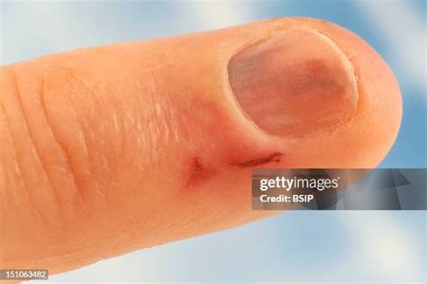 open wound skin   premium high res pictures getty images