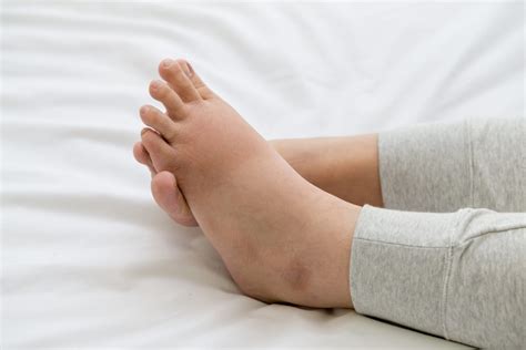 Elephantiasis: A Rare Tropical Disease - Facty Health