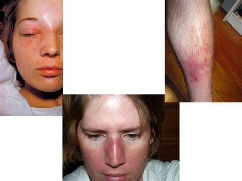 Skin and Soft tissue infections | PPTX