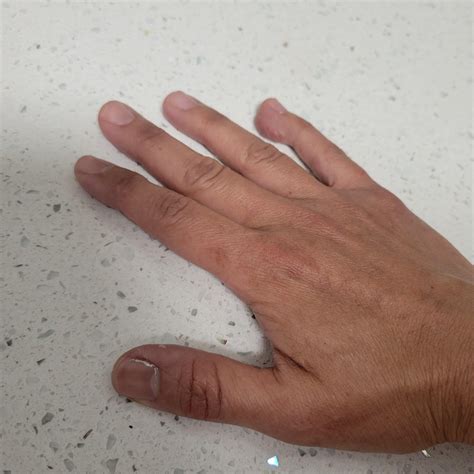 Otezla question : r/PsoriaticArthritis