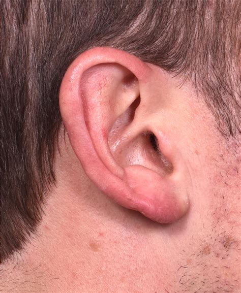 Earlobe Lump Earlobe Cyst How To Get Rid Of A Lump In EarLobe?