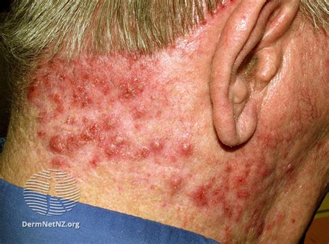 Folliculitis - The London Skin And Hair Clinic