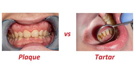 Plaque Vs. Tartar: 3 Key Differences – Difference Camp