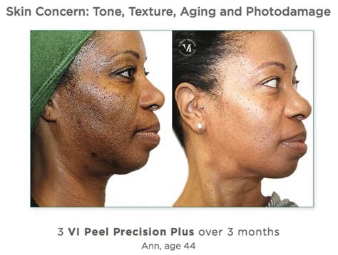 VI Peel Precision Plus Before & After - ANEWU Medical Spa