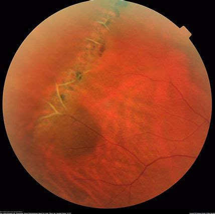 Lattice Degeneration | Annan Retina Eye Center in Houston, Texas