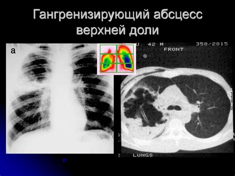 Хирургия абсцесса и гангрены легкого - презентация онлайн
