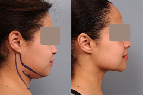 Face Liposuction Before And After