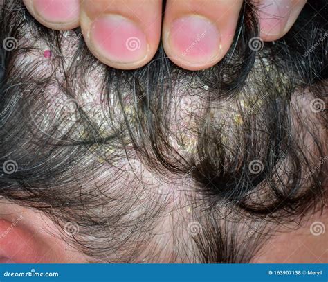 Eczema Hairline