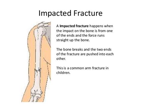 Staff Nurse Vacancy: Fractures Types Nursing Interventions