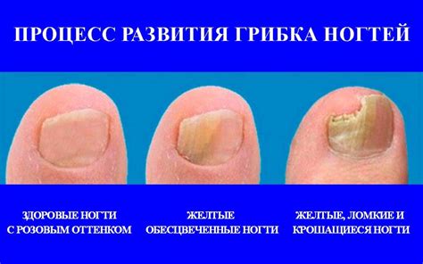 Грибок ногтей: опытный врач дерматолог, миколог в Москве.