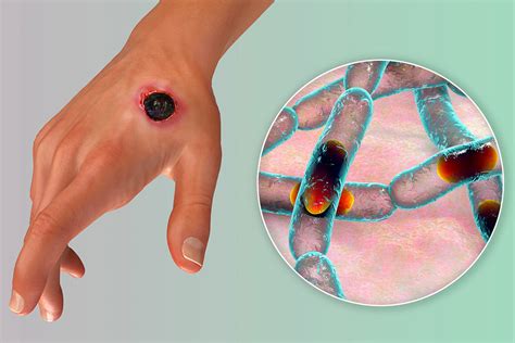 Five things you need to know about anthrax