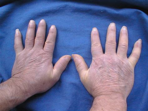 systemicsclerosis nysora nysora