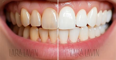 Facetas De Porcelanas Antes E Depois - Facetas de Porcelana Antes e Depois - Dra. Lara Lavin