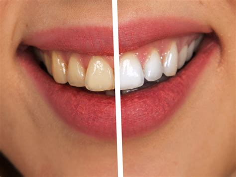 Hydrogen Peroxide Teeth Before After