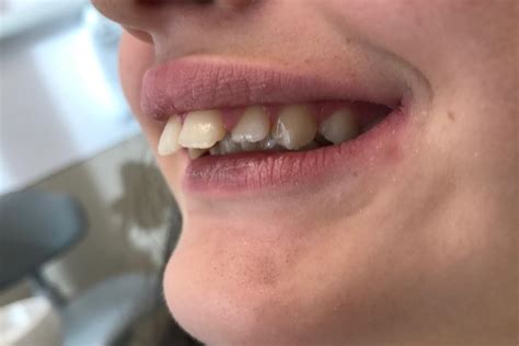Bocas e baldrocas: Tenho os dentes de cima muito para a frente. Preciso ...