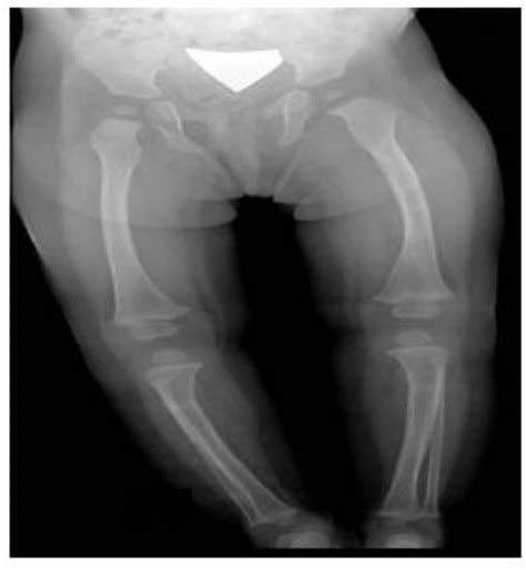 Symptomatic congenital syphilis: still a reality | BMJ Case Reports