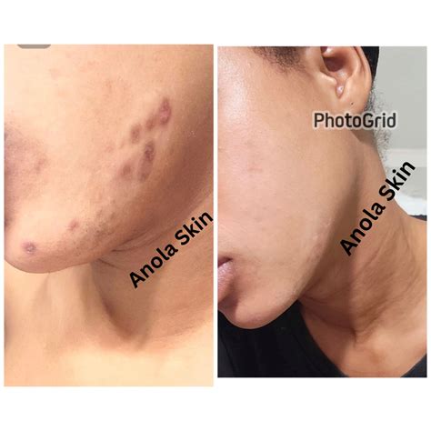 Intense Discoloration Treatment (Rapid Action)