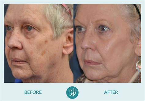 Indianapolis Skin Resurfacing Before & After Photos | Winslow Facial ...