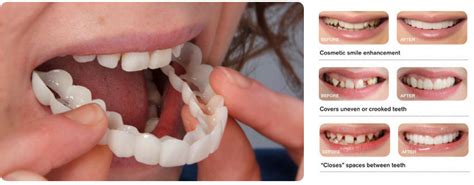 ХИТ! Зубная накладка "Snap-On Smile": купить в Москве и Санкт ...