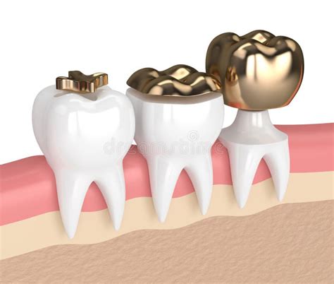 3d Render of Teeth with Different Types of Dental Gold Filling Stock ...