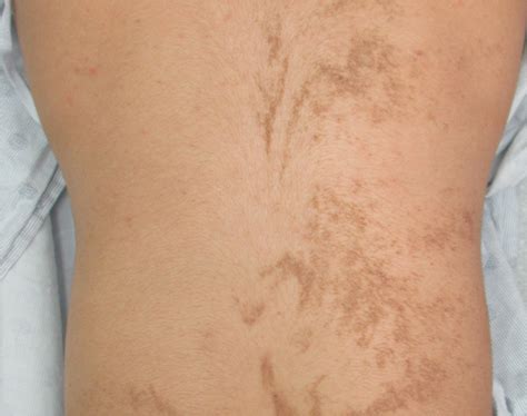 Epidermal Nevus (EN) | School of Medicine