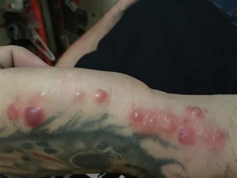 Bed Bug Bite Symptoms - Metro Vancouver Pest Control Service - Customer's Choice