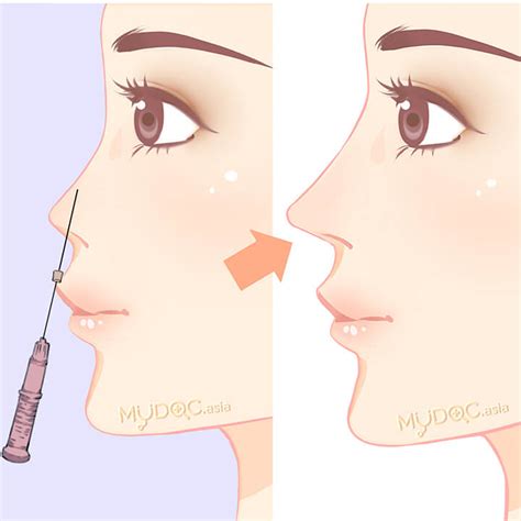 Best Nose Shape Treatment in Premier Clinic Group