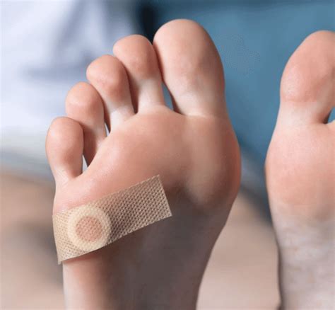 Callus & Corn Removal Knaresborough - Stray Podiatry & Chiropody