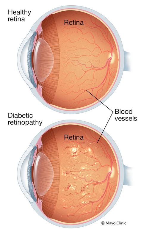 diabetic retinopathy beacon health system