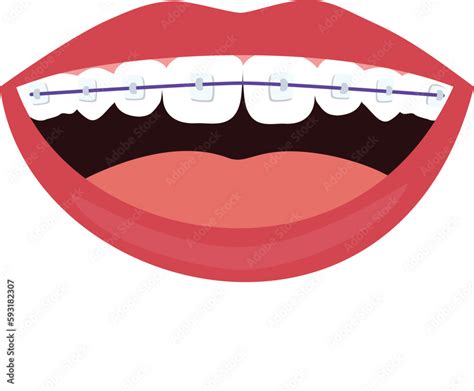 Teeth with braces on white background. Braces Corrective Orthodontics ...