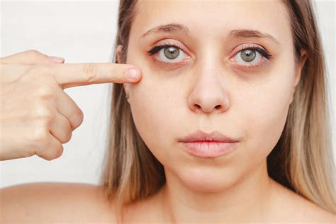 Ectropion: An In-Depth Look at Symptoms, Causes and Treatment Options ...