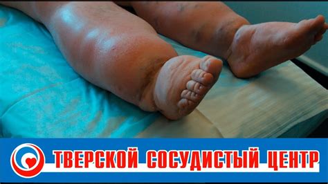 Лечение лимфостаза, лимфедемы (слоновость) - YouTube
