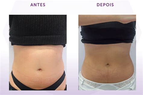 Mini Lipo Na Barriga Antes E Depois