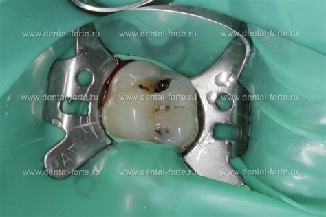 Лечение кариеса 26 зуба - Стоматология Набережные Челны - DENTAL FORTE ...