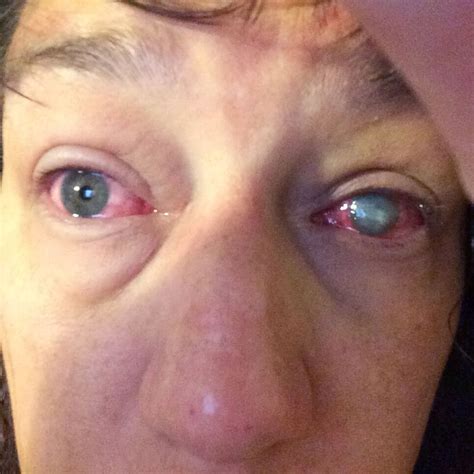Eye Infection From Contacts Managing Contact Lens Related Bacterial