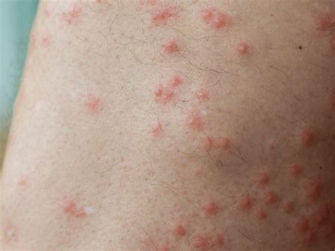 9 common types of insect bites