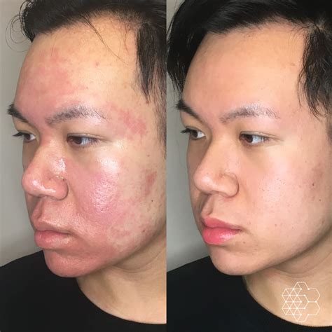 Differences Between BBL Vs IPL Treatments | Skin Technique