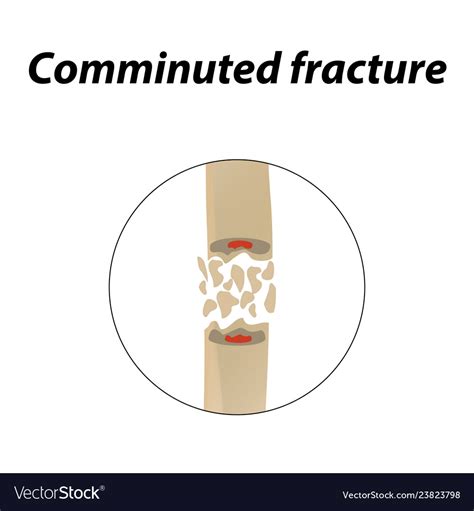comminuted fracture bone infographics royalty  vector