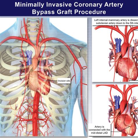 Minimally Invasive Coronary Artery Bypass Graft Procedure ...