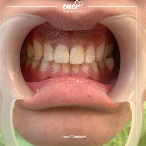 🦷 ХУГАРСАН ШҮДНИЙ ЁЗООРЫГ... - Ener family dental clinic