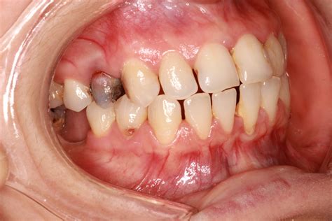 Циркониеви Коронки София- BB Dental Clinic