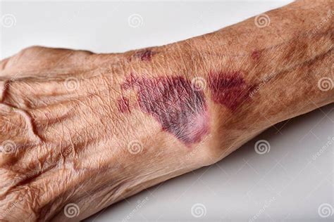 Bruise Wound on Senior People Wrist Arm Skin, Falls Injury Accident Stock Image - Image of hurt ...